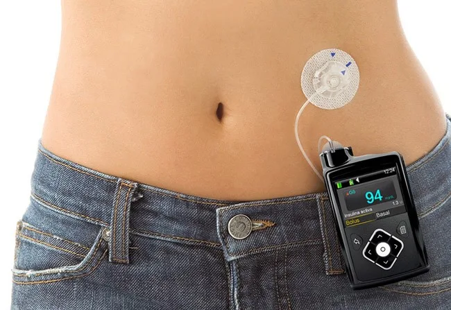 abdomen de una mujer con una bomba de insulina colocada